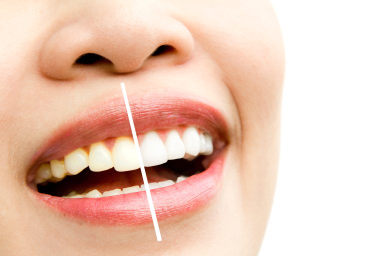 Teeth whitening at Rose House Dental