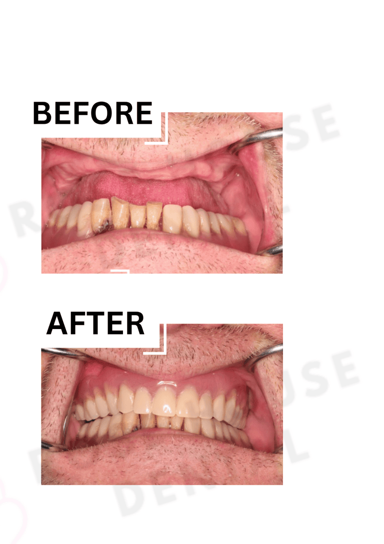 Emergency dentures in letchworth and hitchin
