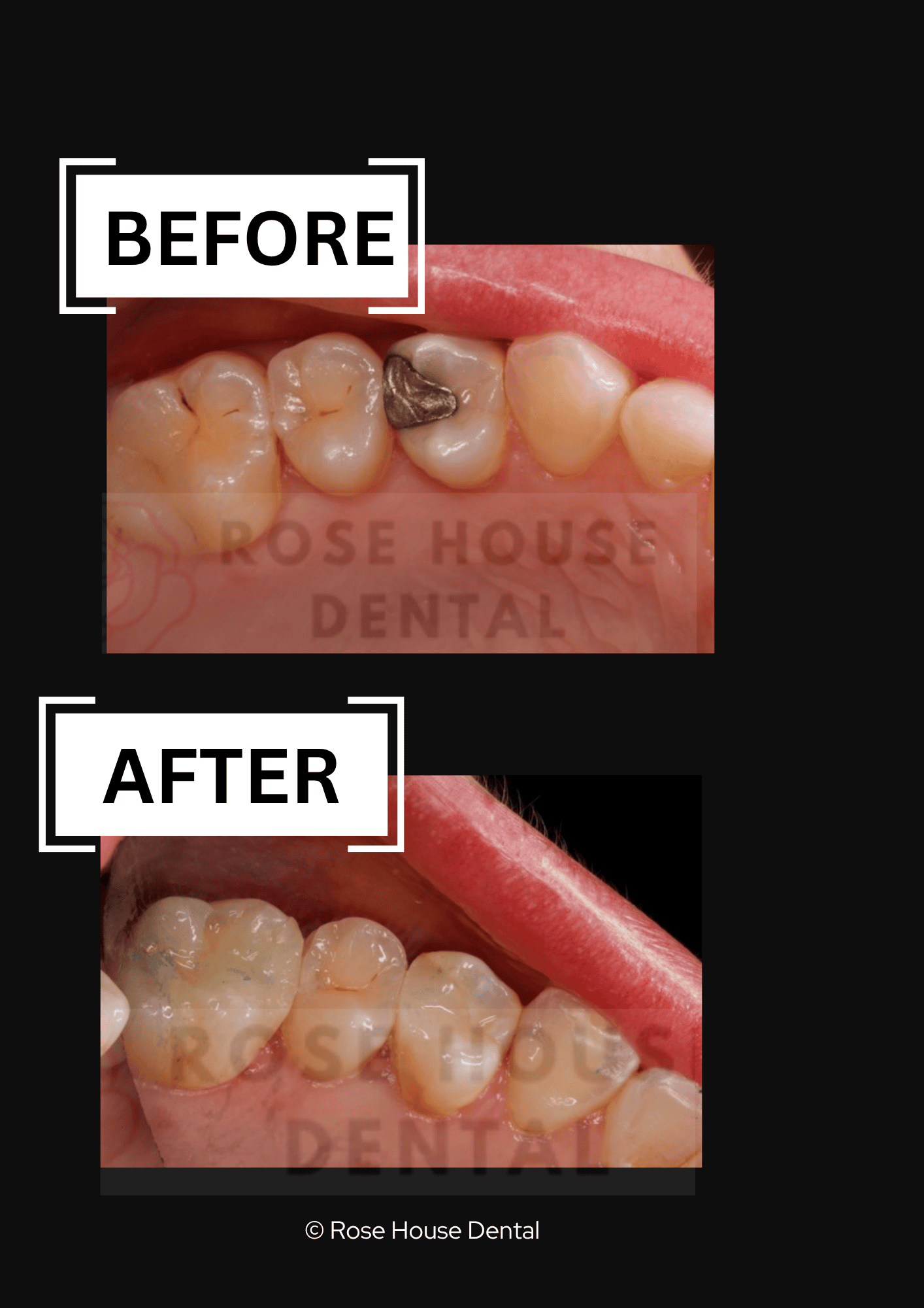 Dr Mistry amalgam removal at Rose House Dental